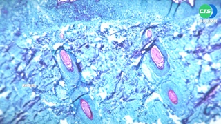全球猴痘延燒 世衛下周召開緊急會議