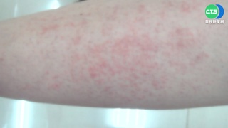 新冠康復後長"丘疹" 皮膚科醫:患者增3成