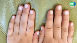 病毒入侵血管 確診6歲童指甲一夕變白