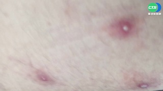 猴痘傳染力"1傳2"? 醫籲提高警覺勿輕忽