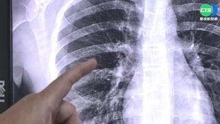 以為長新冠! 連咳5周 竟是確診+黴漿菌惹禍