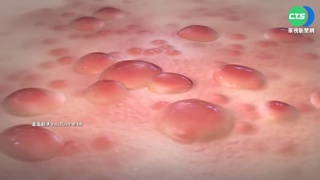 第2例猴痘境外移入! 30多歲男自美國返台