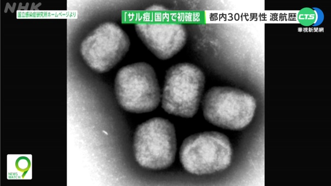日本東京猴痘首例 30多歲男遊歐入境後確診 | 華視新聞