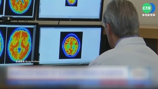誤導方向16年? 美阿茲海默症關鍵研究疑造假
