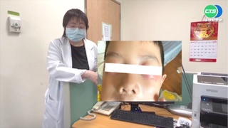 5歲男童確診後"皮蛇"繞眼眶 視力恐受損