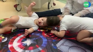 巴西頭部相連雙胞胎 手術分割順利存活