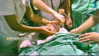 【歷史上的今天】卅多醫護動手術 分割連體雙胞兄弟