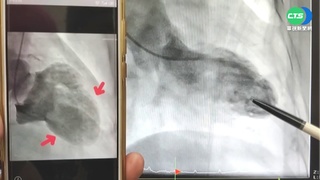 3個月內痛失3至親 女罹"心碎症候群"險亡