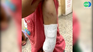 3歲女童滿身瘀青.被菸頭燙 疑親媽.同居人施虐