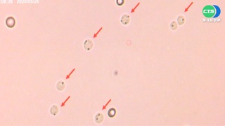 醫學突破! 北榮顯微注射 圓精細胞也能生子