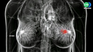 每天8人死於乳癌 建議45歲以下定期檢查