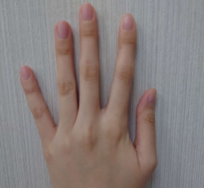 指甲看健康！中醫診所分享指甲7外觀、4顏色要留意 | 華視新聞