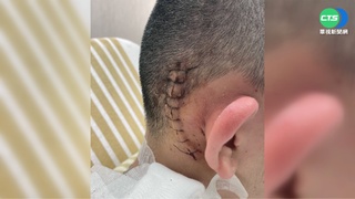 遲緩兒開學15天被打4次 施暴者讚:老師人超好