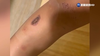 公園石階隨機放燃香? 小女童小腿遭燙傷