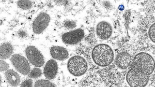 研究:英53%猴痘病例 出現無症狀傳播