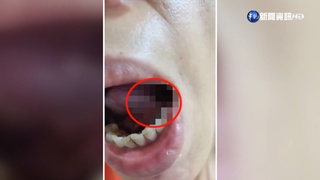 婦拔牙舌頭被"鑽破洞" 牙醫稱"只是破皮"