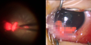 4歲童鉛筆插眼.術後留後遺症 醫籲：孩子盡量不接觸尖銳物