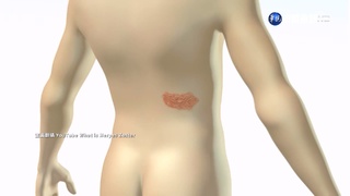 天冷好發帶狀皰疹 醫生:50歲以上患者增兩成