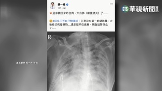 醫曝X光驚見大白肺 60歲台商確診病危插管