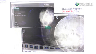 6歲女童罹急性鼻竇炎　醫疑長期戴口罩悶住