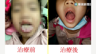 女童嘴舌長紅疹痛到吃不下 疑遭誤診腸病毒