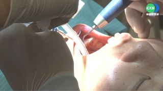 洗牙後牙齒敏感不舒服？醫師列4點常見「後遺症」：是警訊