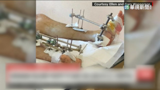 烏軍官面臨雙腿截肢　志工聯繫赴美重建