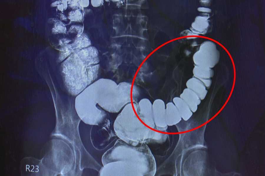 邱建銘主任從大腸攝影檢查發現，江小姐腸子繃得非常緊。 / 圖片來源 台中慈濟醫院