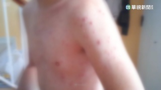 首見猴痘2本土個案.匡列25人　皆無出國紀錄