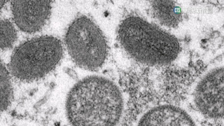 猴痘新增4例本土案例！疾管署：如有疑似症狀　應儘速就醫並告知接觸史