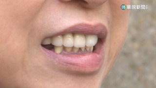 花2萬做陶瓷牙套狀況多！　女控成暴牙.牙縫大