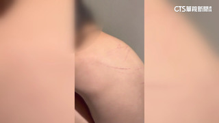 幼兒園不當管教？　3歲童背部受傷　父怒：絕不縱容