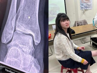 高嘉瑜美機場出意外「腳腫得像麵龜」  回國照Ｘ光醫吐最壞結果