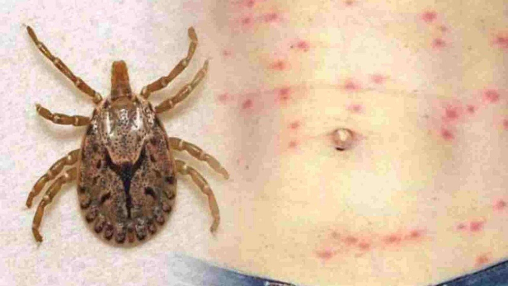 恙蟎幼蟲及恙蟲病皮膚紅疹。圖片來源 高雄市立民生醫院 提供
