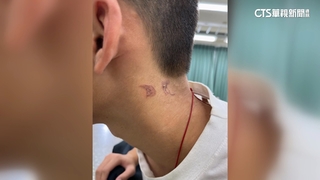 球隊教練打火機燙球員　竹市府：各校永不錄用