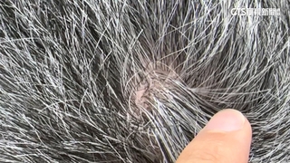 讓「黑色素細胞」再活化？　美科學家拚白髮轉黑