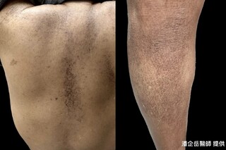 皮膚搔抓別過度！　醫師示警：產生蟾蜍樣皮難去除