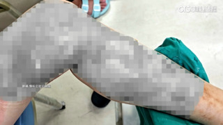 月子餐員工燙傷腿　控公司要求勿通報職災