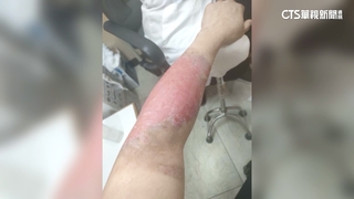 老鼠咬破管氣爆　攤商燙傷控北市府卸責