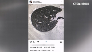 不菸不酒罹肺癌　「最美護理師」崩潰：我才30歲