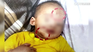 非法托嬰又虐嬰　未滿1歲男嬰遭毆全身瘀青