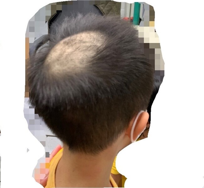 幼兒園餵藥案延燒　小朋友為驗髮「頭禿一塊」 網心疼：你超勇敢 | 華視新聞