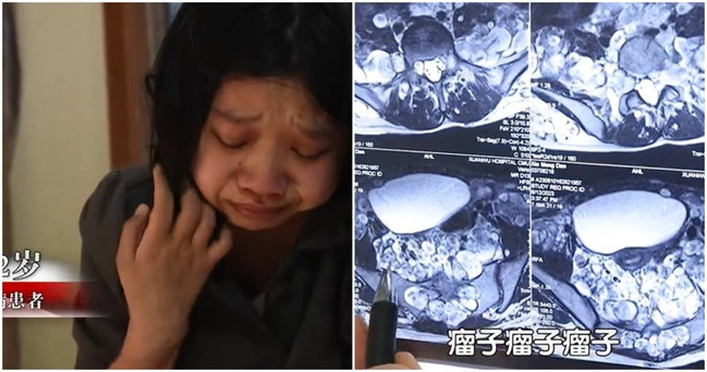 22歲女體內長滿「上千顆腫瘤」　醫師曝：不治療恐在痛苦中死去 | 華視新聞