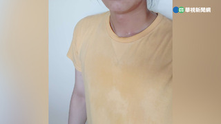 有無狐臭可從「耳垢」得知？　皮膚科醫師：「這種」耳垢易得狐臭