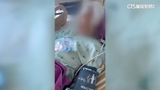 恐怖情人！　5旬婦要分手遭男打破頭住進加護病房