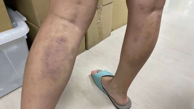 婦「撥筋」後 小腿肚大片瘀青「如家暴傷」　醫師示警：8類人應避免 | 華視新聞