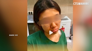 女每日吃近500克胡蘿蔔　3個月後「膚色變橘黃」