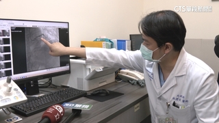 天冷！急診1小時送來3腦出血病患　醫籲：注意保暖