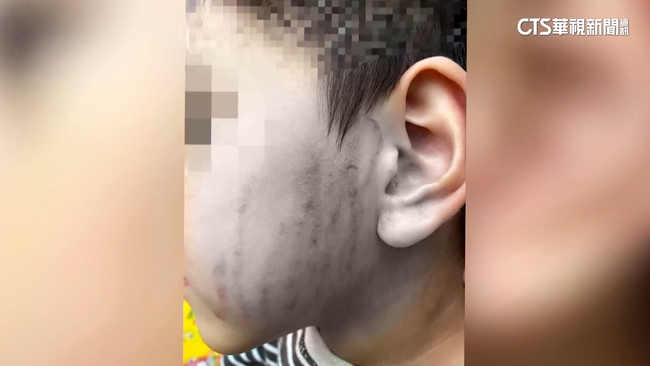 家長氣炸！4歲童抓同學臉　幼保員反抓「讓他體驗痛」 | 華視新聞