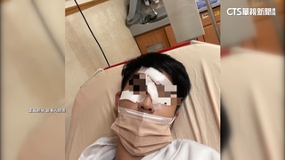 鐵架掛半空　學生慘撞濺血臉縫針「差1.5公分傷眼」